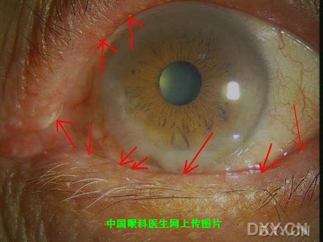 请看图中,睑板腺有问题