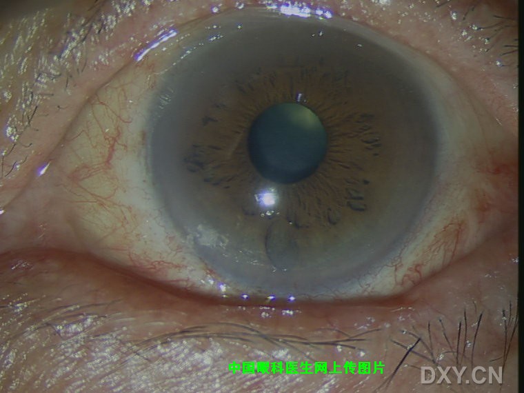 角结膜上皮内肿瘤(conjunctiva-cornea intraepithelial neoplasia,cc