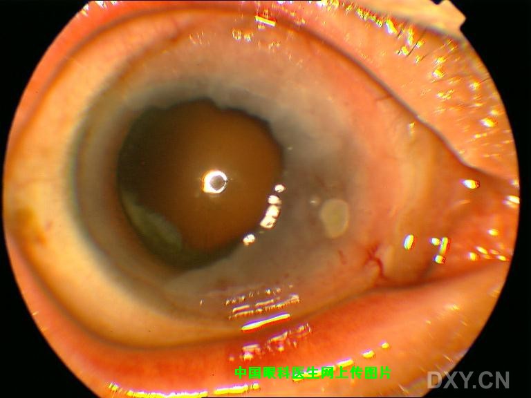 角结膜上皮内肿瘤(conjunctiva-cornea intraepithelial neoplasia,cc