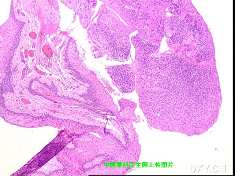 角结膜上皮内肿瘤(conjunctiva-cornea intraepithelial neoplasia,cc